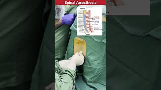 How spinal Anesthesia procedure is performed in Surgery doctor mbbs neet medical anesthesia [upl. by Ydnor]