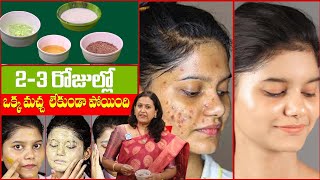 Remove Pimples and Acne Scars by Homemade Face Pack  Dark Spots  Dr Jyothsna  iD Health 360 [upl. by Aleicarg521]