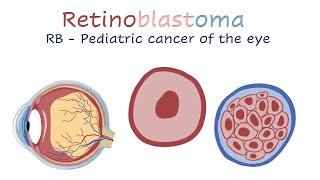 Retinoblastoma [upl. by Nahum964]