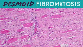 Desmoid Tumor Fibromatosis explained in 5 minutes pathology usmle FAP familial adenomatosis coli [upl. by Eevets978]