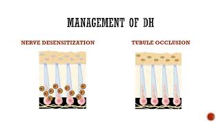 Dentinal Hypersensitivity [upl. by Akisey]