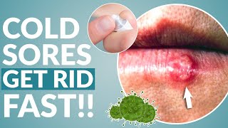 How to Get Rid of Cold Sore Fast [upl. by Marlyn714]