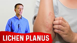 Lichen Planus Best Remedy [upl. by Narah]