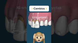 Incisors intruded orthodontics ортодонтия kieferorthopädie विषमदंत ortodonzia orthodontie [upl. by Dyoll604]