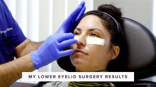 Real Lower Blepharoplasty Recovery amp Results  In the OR Part 3 of 3 [upl. by Pudens]