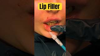 Lip Filler Tutorial channel [upl. by Enelhtak]