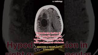 NEOPLASTIC ETIOLOGY CT BRAIN [upl. by Aivalf]