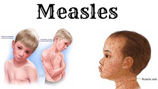 Everything about MEASLES in detail and simple [upl. by Corliss]