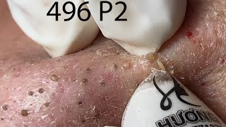 Make your Acne Treatment Huong Da Nang496  acne 2022 Part2 [upl. by Nnyw401]