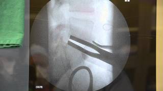 Lumbar Artificial Disc Replacement Surgery Synthes ProdiscL [upl. by Natrav]