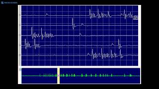 Kimura amp Kohara F34 Typical myokymic discharge seen in a demyelinating neuropathy [upl. by Tterrej]