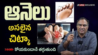 Corn Treatment With VRK Diet  Dr VRK About Corn Removal From Feet at Home  Remove Foot Corns [upl. by Pelagi385]