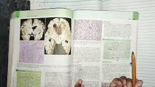 CNS tumors part 3 oligodendrocytoma ependymoma cnspathology robbins pathology [upl. by Abercromby574]