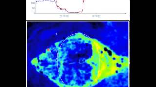 Cardiac Arrest  Perfusion Measurement in Brain [upl. by Akihsar198]