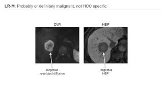 Imaging HCC and LIRADS [upl. by Myer]