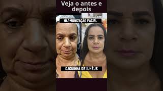 Gaga de Ilheus passa por harmonização facial [upl. by Ruphina]