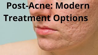 PostAcne Modern Treatment Options [upl. by Idorb904]