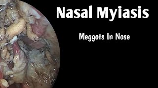 Nasal Myiasis  ENT [upl. by Ninetta2]