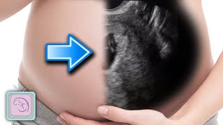 How to predict if you will have an early miscarriage with ultrasound [upl. by Kalil]