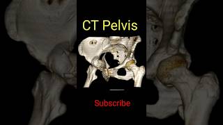 CT Pelvis 3D shorts radiology ctpelvis RadiologyJunction1 [upl. by Atiuqad]