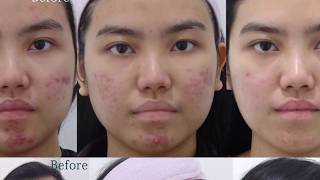 Lutronic Spectra amp Gold Toning Laser Treating Acne amp Redness at BeauampHans Aesthetic [upl. by Aelegna]