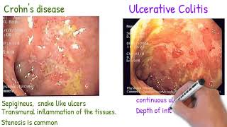 Crohns disease vs Ulcerative Colitis made simply [upl. by Lasser]