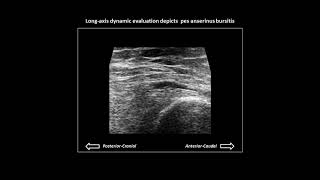 Pes anserinus bursitis on knee ultrasound [upl. by Keefer]