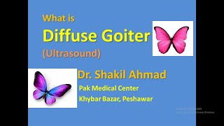 What is Diffuse Goiter Ultrasound features [upl. by Nosydam217]