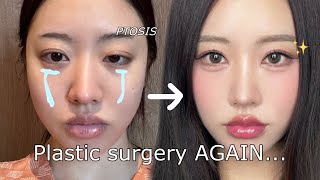 I got my eyes done AGAIN in korea😭 Plastic surgery vlog [upl. by Sverre592]