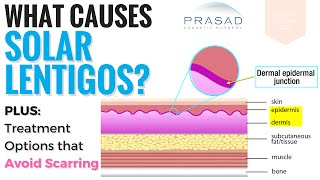 Causes and Treatments for Solar Lentigos [upl. by Philbrook198]