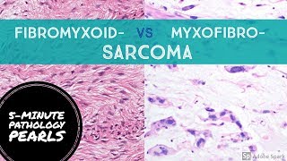 FIBROmyxo vs MYXOfibro Sarcoma Made Simple 5Minute Pathology Pearls [upl. by Iaht]