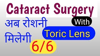 अब रोशनी मिलेगी 66 । toric lenses for cataract surgery। Toric lens price [upl. by Brana]