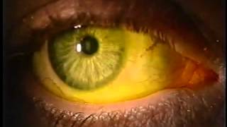 Instilling Fluorescein Dye in the Eye [upl. by Naynek]