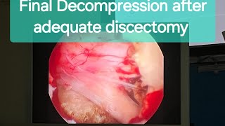 InterLaminar Endoscopic Discectomy Awake Spine Surgery Dr Rohit Thaker sciaticatreatment spine [upl. by Itch679]