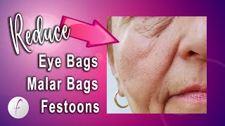 How to Reduce Malar Bags Eye Bags and Festoons [upl. by Luapnaes]