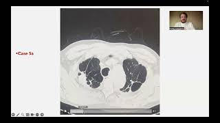 What you need to know about Pleuroparenchymal fibroelastosis part 2 English version [upl. by Ayyidas]