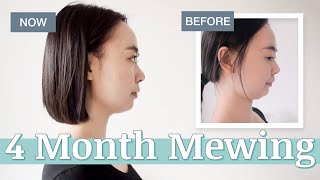 4 Months Mewing Before amp After at Age 28 [upl. by Ettennej]