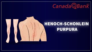 Henoch Schonlein Purpura [upl. by Assetniuq224]