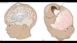 Intraventricular hemorrhage IVH of the newborn [upl. by Gone675]