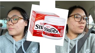 TRYING STRIDEX FOR A WEEK  MY ACNE JOURNEY [upl. by Mehelhteb]