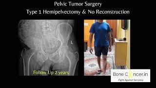 Treatment for Bone Cancer Chondrosarcoma Pelvic Tumour SurgeryHemipelvectomy Dr Srimanth B S [upl. by Allisurd]