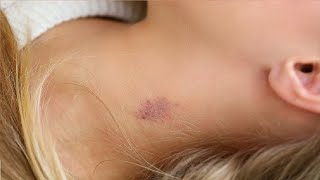 how to give a fake hickey on your neck very easy [upl. by Louise27]