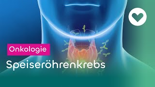 Speiseröhrenkrebs  Symptome Risikofaktoren und Therapie [upl. by Adelind163]