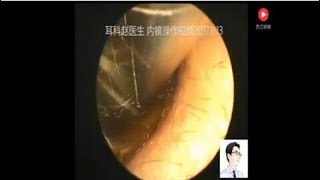 Earwax Removal ExtractionA case of elderly cerumen ears [upl. by Enitsirhc]