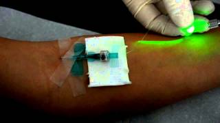 Intravenöse Laserblutbestrahlung mit dem Weberneedle® Endo Laser [upl. by Ekaj]