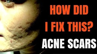 How to treat acne scars  Dermatologist explains [upl. by Loralee]