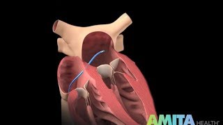 What Is Catheter Ablation — AMITA Health [upl. by Skelly766]