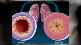 Signs and symptoms of bronchitis Natural herbs treatment of chronic bronchitis [upl. by Lilah]