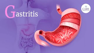 What is Gastritis  Causes Symptoms Complications and Treatment  CARE Hospitals [upl. by Atiuqal433]