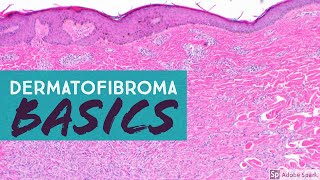 Dermatofibroma 101 Benign Fibrous HistiocytomaExplained by a Dermatopathologist [upl. by Roanna319]